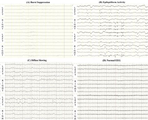 normal vs abnormal eeg